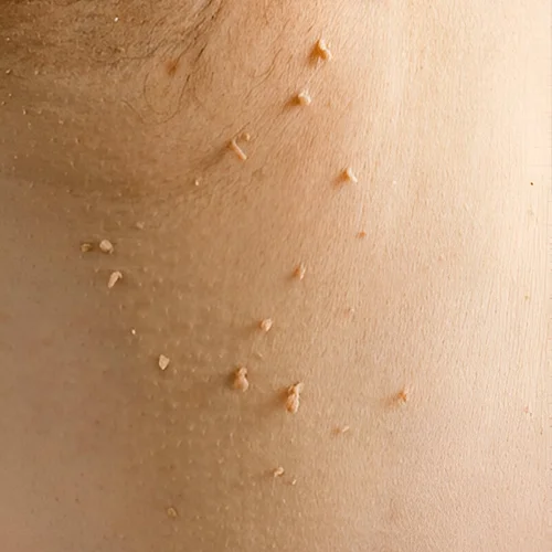 Minor Skin Procedures