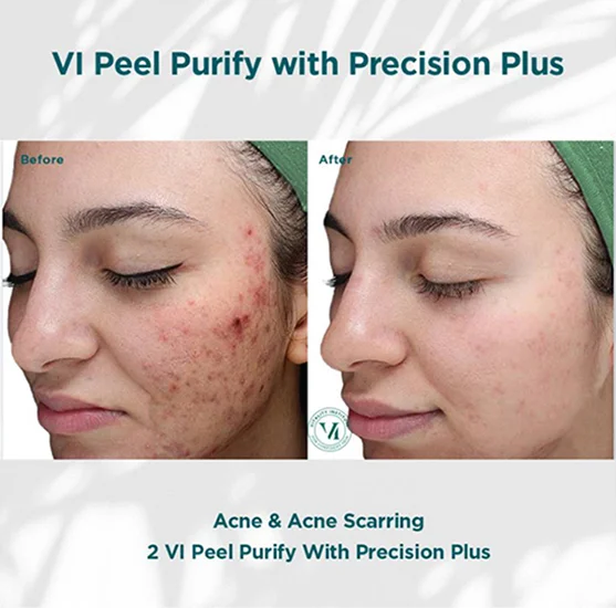 VI Peel Purify with Precision plus