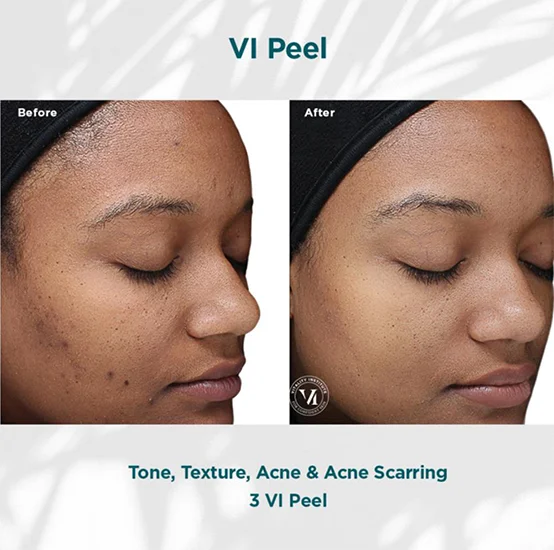 VI Peel