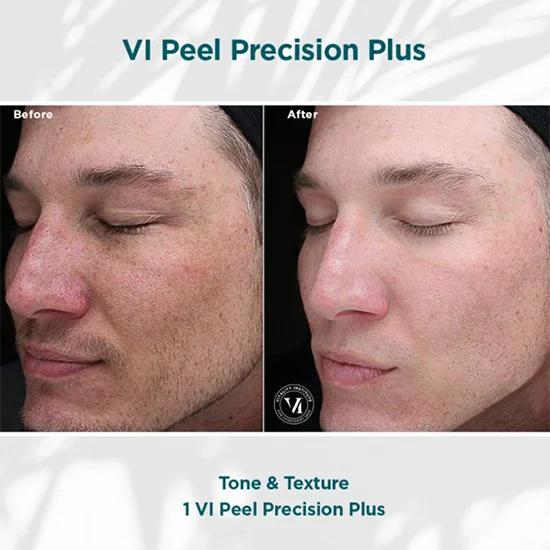 VI Peel Precision plus
